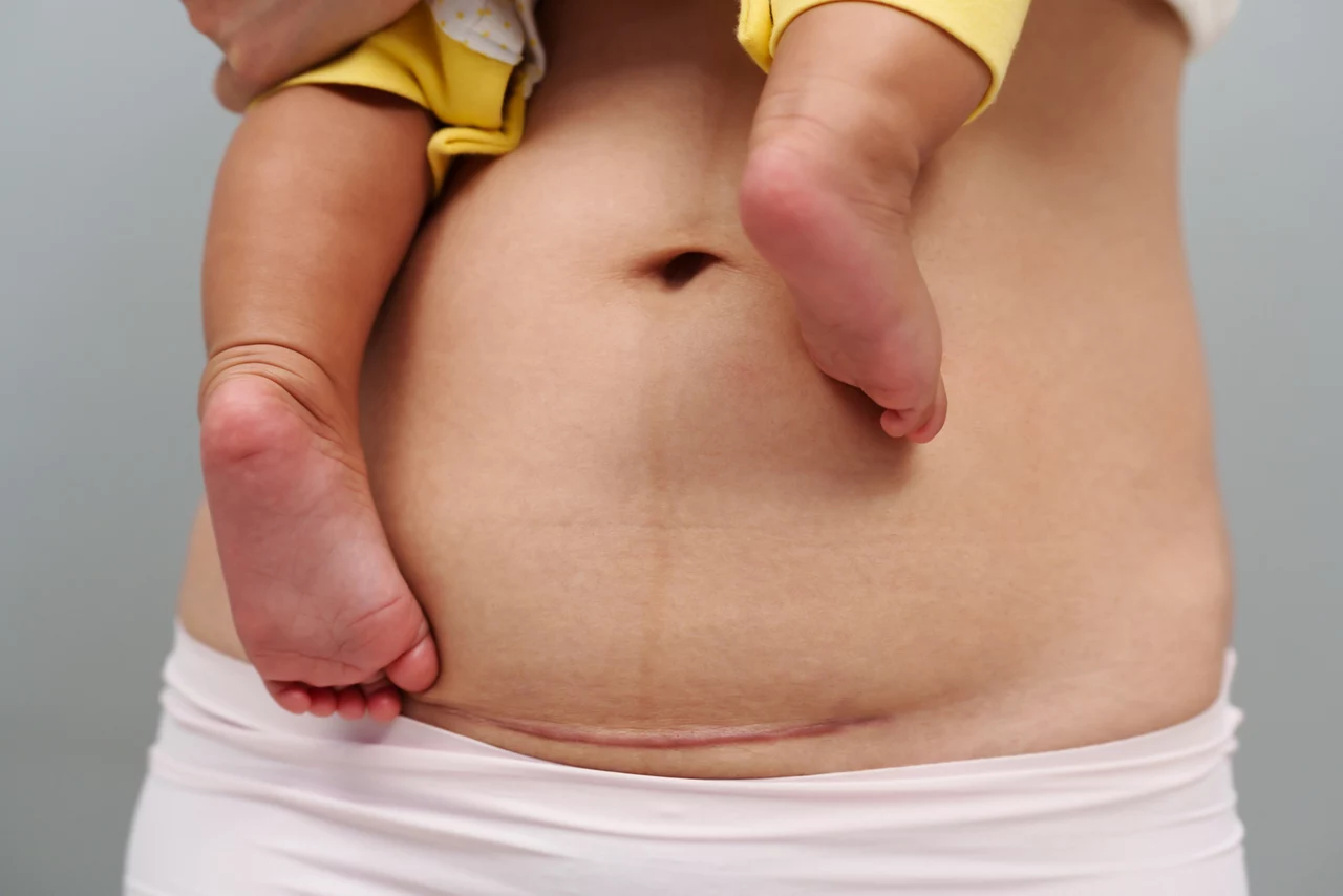 C-Section