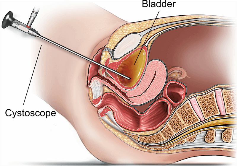 Cystoscopy