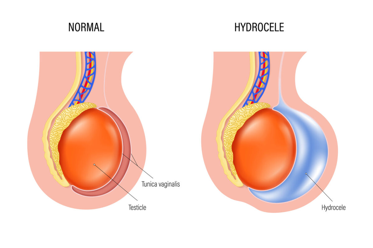 Hydrocele